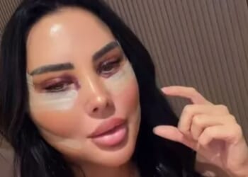 Towie's Yazmin Oukhellou hits back at trolls who claim she's too young for a face lift with sassy post-surgery video
