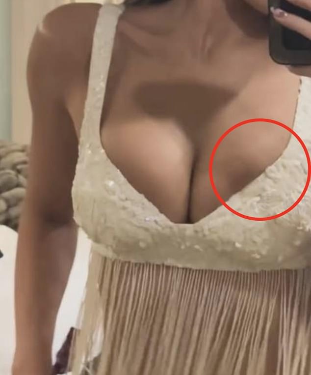 Eagle-eyed followers quickly took to social media after claiming they noticed something unusual about her left breast implant
