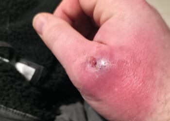 Explosion of ‘UK’s most dangerous spider’ as number of Brits in hospital with horror bites doubles