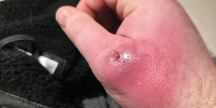 Explosion of ‘UK’s most dangerous spider’ as number of Brits in hospital with horror bites doubles