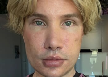 I was left blind and unrecognisable after facelift aged 30…when Turkish surgeons REFUSED me I flew to South Korea for op