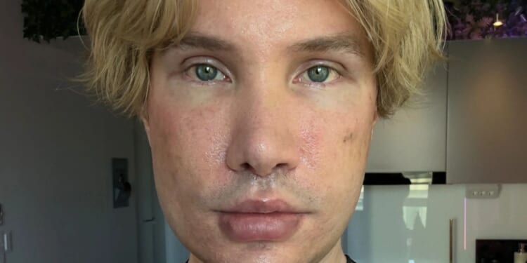 I was left blind and unrecognisable after facelift aged 30…when Turkish surgeons REFUSED me I flew to South Korea for op