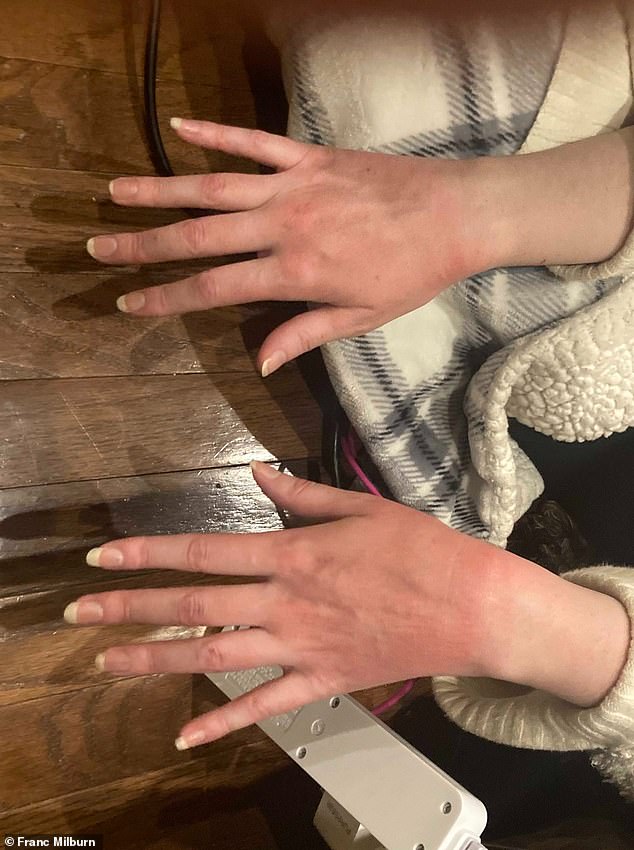 Milburn shared a picture, which he claims shows Eskridge's hands burned and discolored after allegedly being struck by an 'energy weapon'