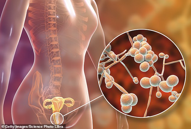 Vaginal thrush is a common yeast infection, caused by an overgrowth of a fungus called Candida