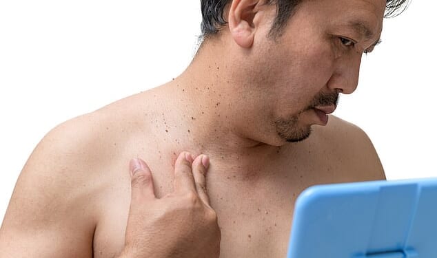 Too much insulin triggers skin tags. The body overproduces the hormone when cells stop responding properly and that excess directly stimulates skin cell growth (stock)