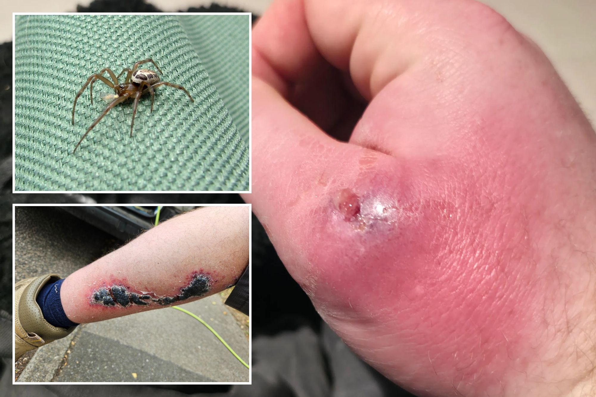 An image collage containing 3 images, Image 1 shows Brit hospitalised after spider bite left him with hand the size of a "bowling ball", Image 2 shows Noble false widow spider (Steatoda nobilis) on a green woven fabric, Image 3 shows The leg of Adam Abrehart showing a severe skin reaction from a noble false widow spider bite