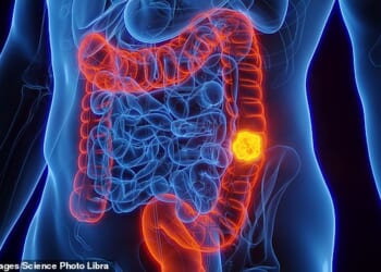 Hopes of a bowel cancer cure have been raised after a groundbreaking clinical trial kept patients cancer-free for nearly three years following a new method of treatment