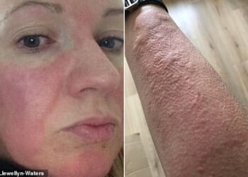 Four weeks after giving birth, I developed a cold allergy, says Kate Llewellyn-Waters