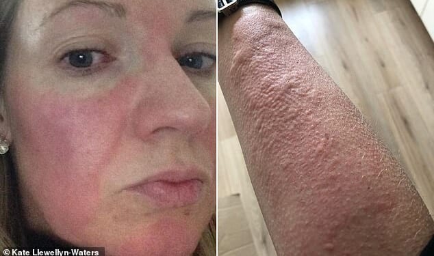 Four weeks after giving birth, I developed a cold allergy, says Kate Llewellyn-Waters