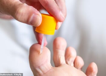 The most common treatment for warts is a topical ointment called salicylic acid