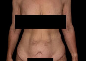 Zehra found she was struggling with excess skin after transformative weight loss