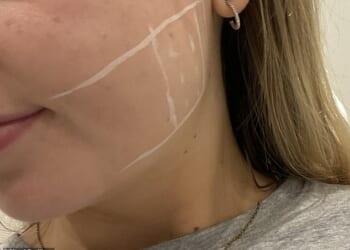 A plastic surgeon drew the incision points on my jawline before injecting the Botox