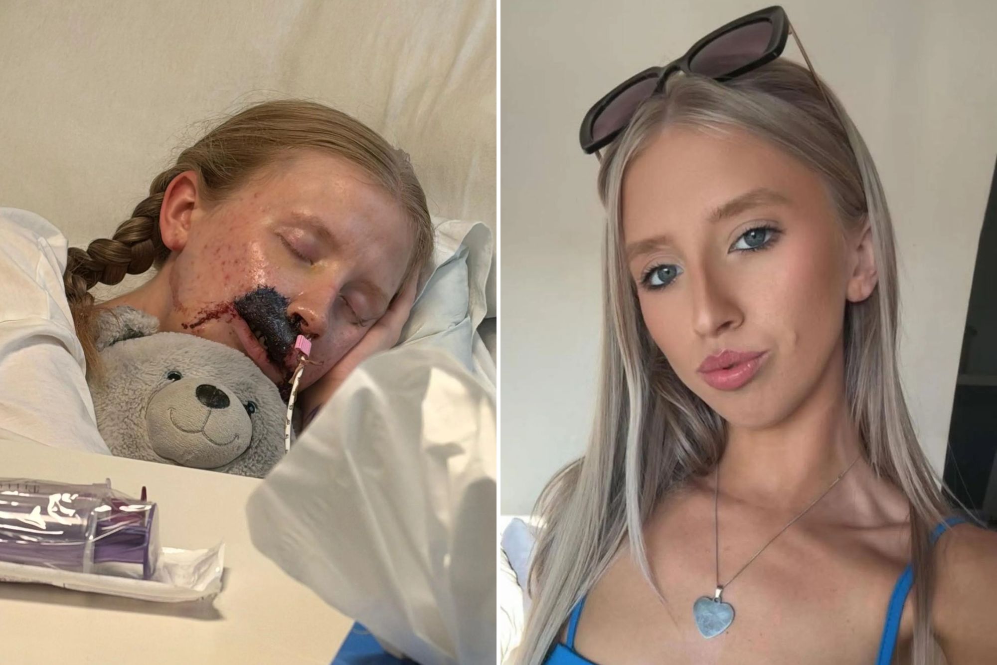 An image collage containing 2 images, Image 1 shows Samantha Redding recovering in hospital from a dog attack, Image 2 shows A young woman with long blonde hair and sunglasses on her head looks directly at the camera