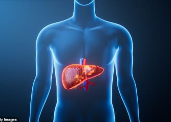 Once thought to be largely caused by heavy alcohol consumption, experts say liver disease is now increasingly linked to modern lifestyle factors such as poor diet