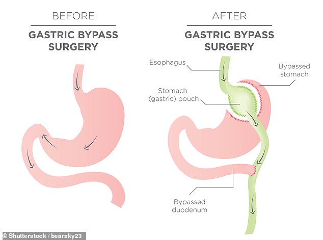 Bariatric surgery, commonly known as weight loss surgery, consists of a variety of potential procedures including gastric sleeves, gastric bypass and gastric band. This illustrated example shows a gastric bypass