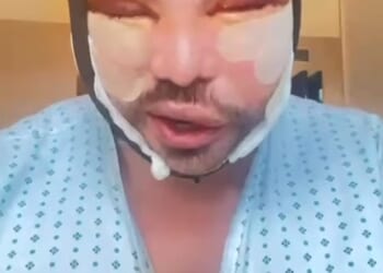 Bobby Norris has shared new pictures of his swollen and bruised face with fans after undergoing more cosmetic surgery