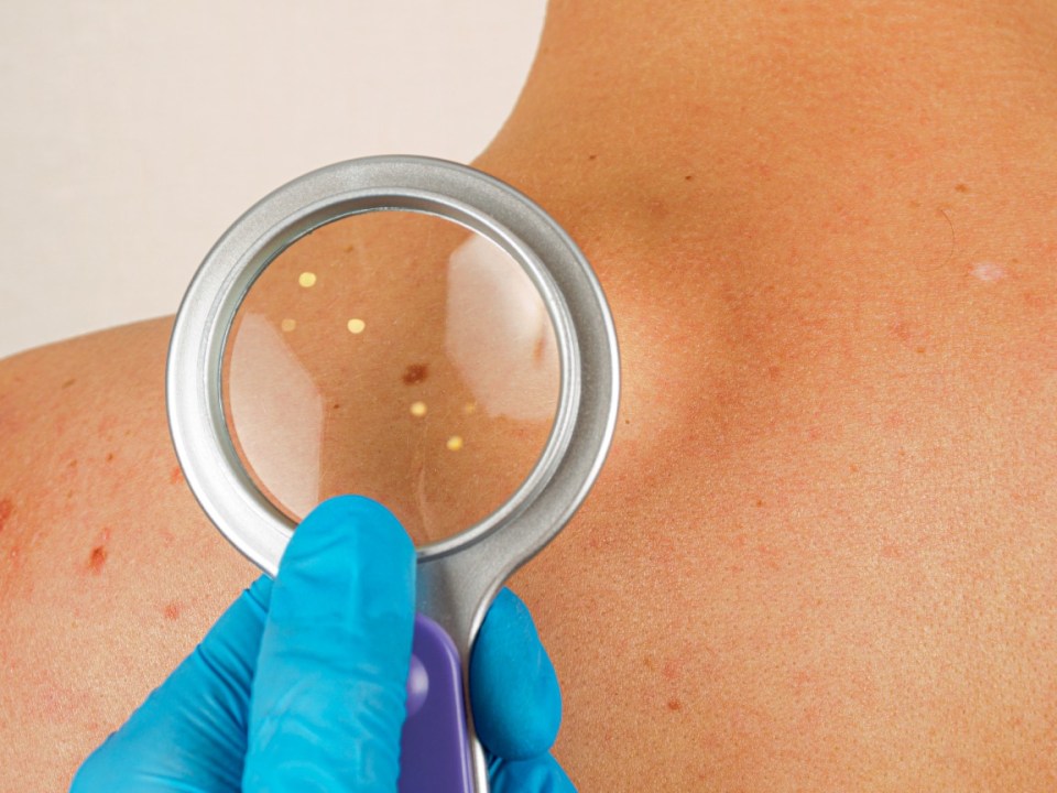 Dermatologist examining moles and formations on a patient's back with a magnifying glass.