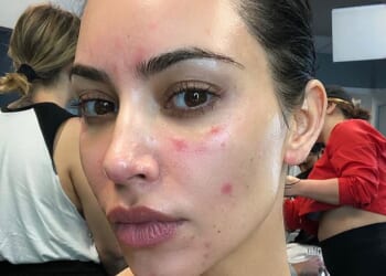 Reality television star Kim Kardashian revealed she had been diagnosed with psoriasis seven years ago