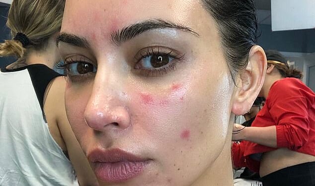 Reality television star Kim Kardashian revealed she had been diagnosed with psoriasis seven years ago
