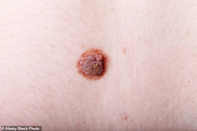 Being exposed to too many UV rays can lead to melanoma - a deadly form of skin cancer