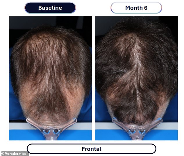The above was among the best results from the experimental form of minoxidil that was tested in the trial