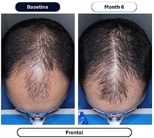 More than 80 percent of men who used the drug said they noted an improvement in their hair loss