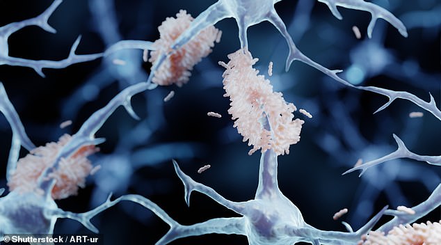 Pictured: An illustration of amyloid plaque forming between neurons in Alzheimer's disease patients