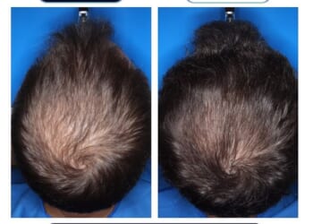 The above was among the best results from the experimental form of minoxidil that was tested in the trial