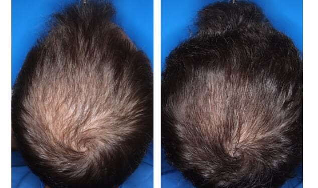 The above was among the best results from the experimental form of minoxidil that was tested in the trial
