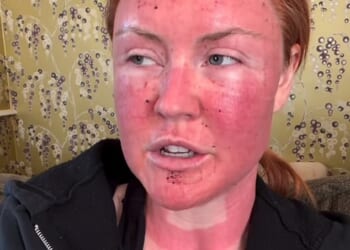 Former Strictly star Chris Robshaw's wife Camilla Kerslake looked unrecognisable with a severely burnt face after undergoing free £1K CO2 laser treatment last week