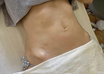 Rosie Green's tummy before the procedure